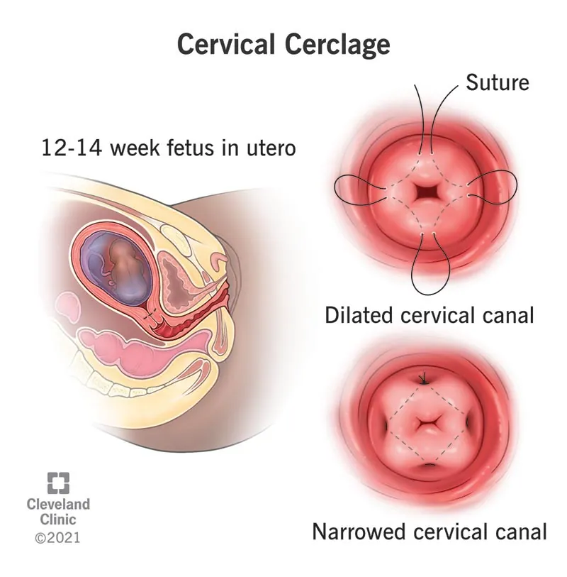 image shows depiction of cervical cerclage . DR. B Ramesh at altius is the best doctor for cervical cerclage in bangalore